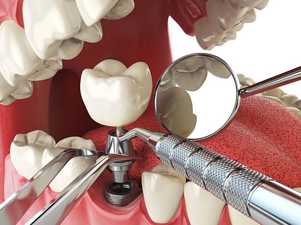Best Emergency Dental Care for Broken or Chipped Teeth in Grimes, IA